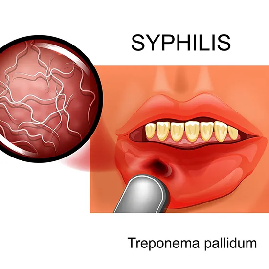 syphilis comprehensive panel test